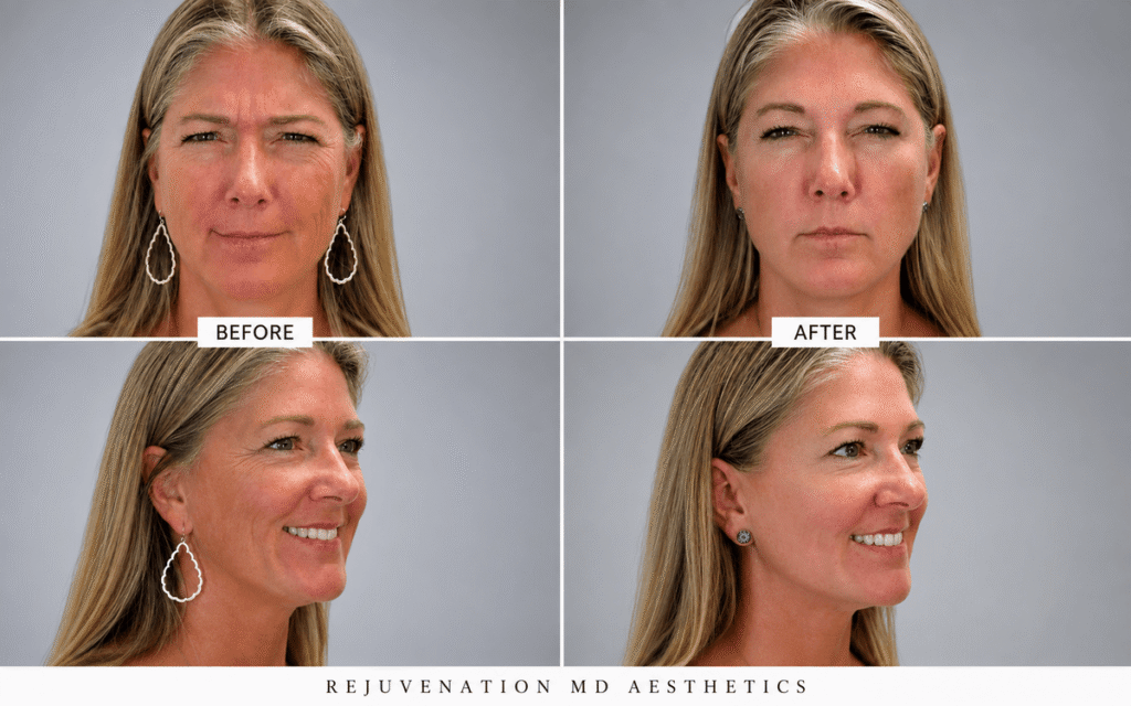 marionette lines botox