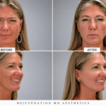 marionette lines botox