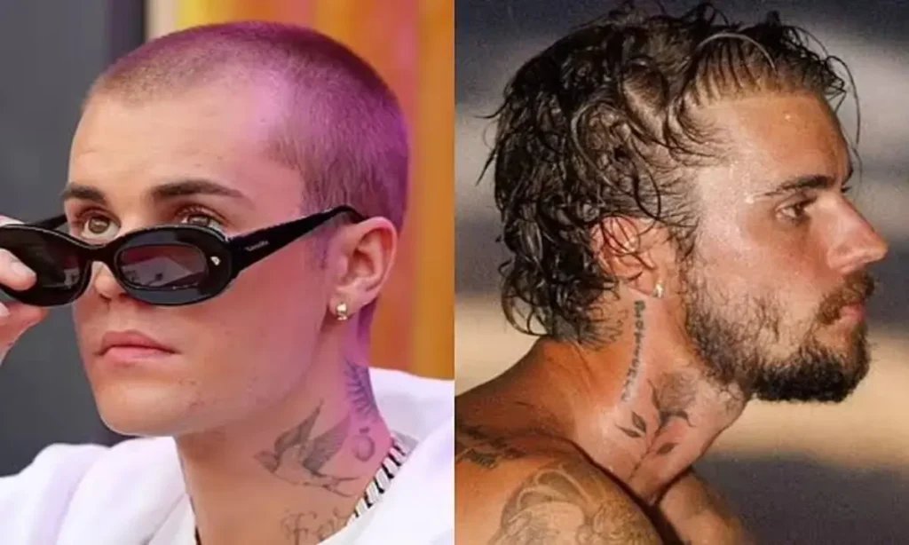 justin bieber hair transplant