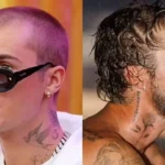 justin bieber hair transplant